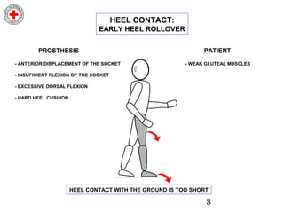 8
- ANTERIOR DISPLACEMENT OF THE SOCKET
- INSUFICIENT FLEXION OF THE SOCKET
- EXCESSIVE DORSAL FLEXION
- HARD HEEL CUSHION
PROSTHESIS
- WEAK GLUTEAL MUSCLES
PATIENT
HEEL CONTACT WITH THE GROUND IS TOO SHORT
HEEL CONTACT:
EARLY HEEL ROLLOVER
 