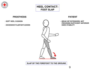 9
- SOFT HEEL CUSHION
- EXCESSIVE PLANTAR FLEXION
PROSTHESIS
- WEAK HIP EXTENSORS, NOT
PROVIDING SUFFICIENT ANTERIOR
KNEE STABILITY
PATIENT
SLAP OF THE FOREFOOT TO THE GROUND
HEEL CONTACT:
FOOT SLAP
 