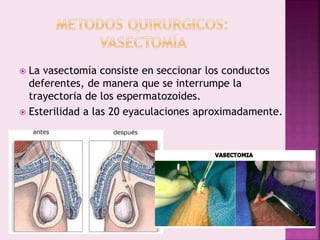  La vasectomía consiste en seccionar los conductos
deferentes, de manera que se interrumpe la
trayectoria de los espermatozoides.
 Esterilidad a las 20 eyaculaciones aproximadamente.
 