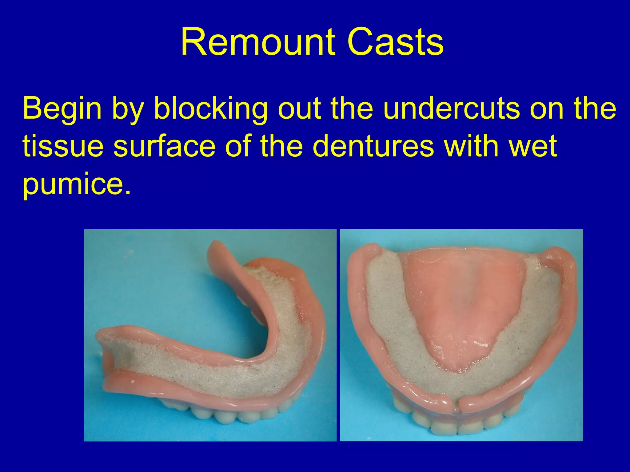 Remount Casts
Begin by blocking out the undercuts on the
tissue surface of the dentures with wet
pumice.
 