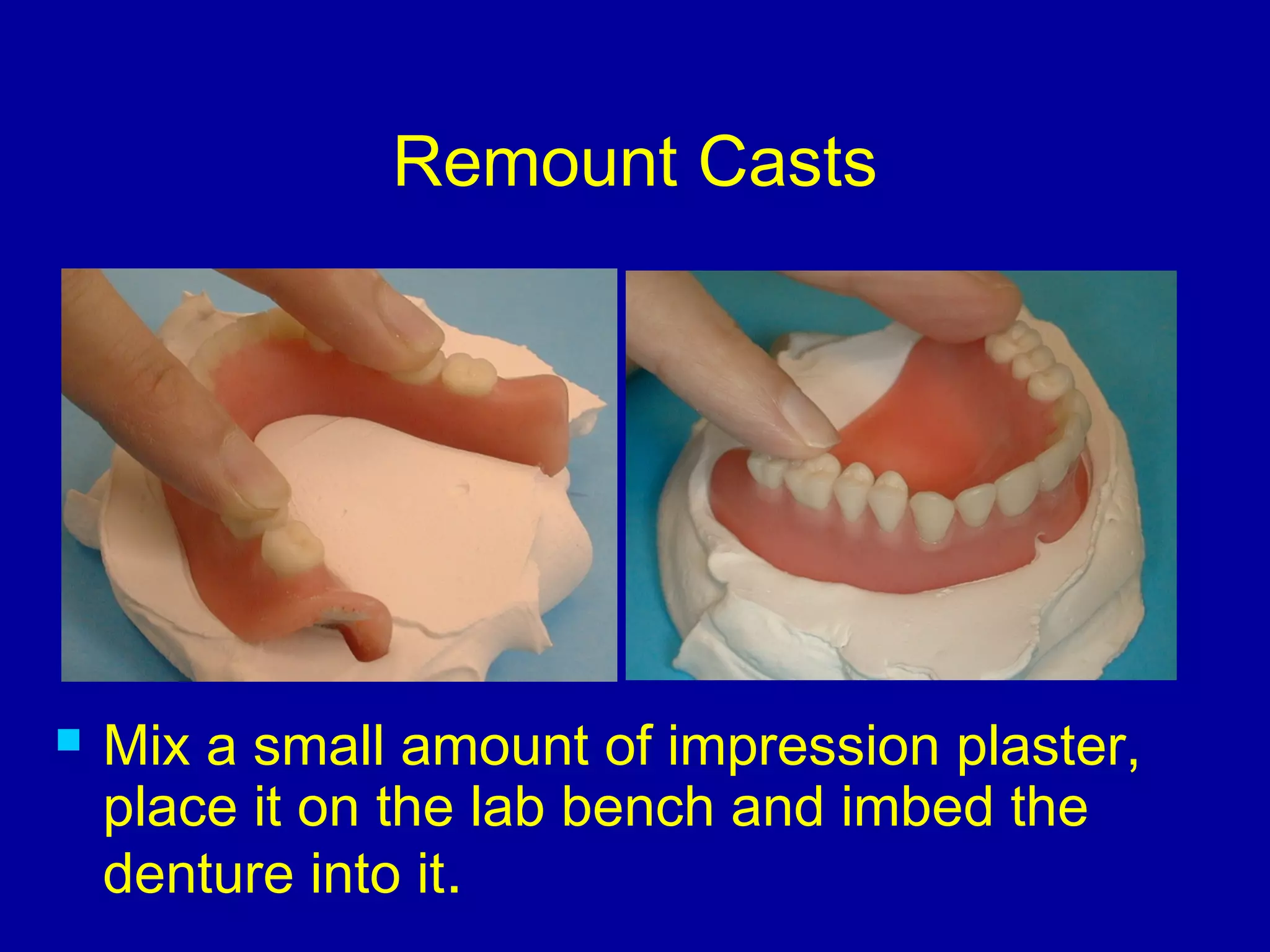 Remount Casts
 Mix a small amount of impression plaster,
place it on the lab bench and imbed the
denture into it.
 