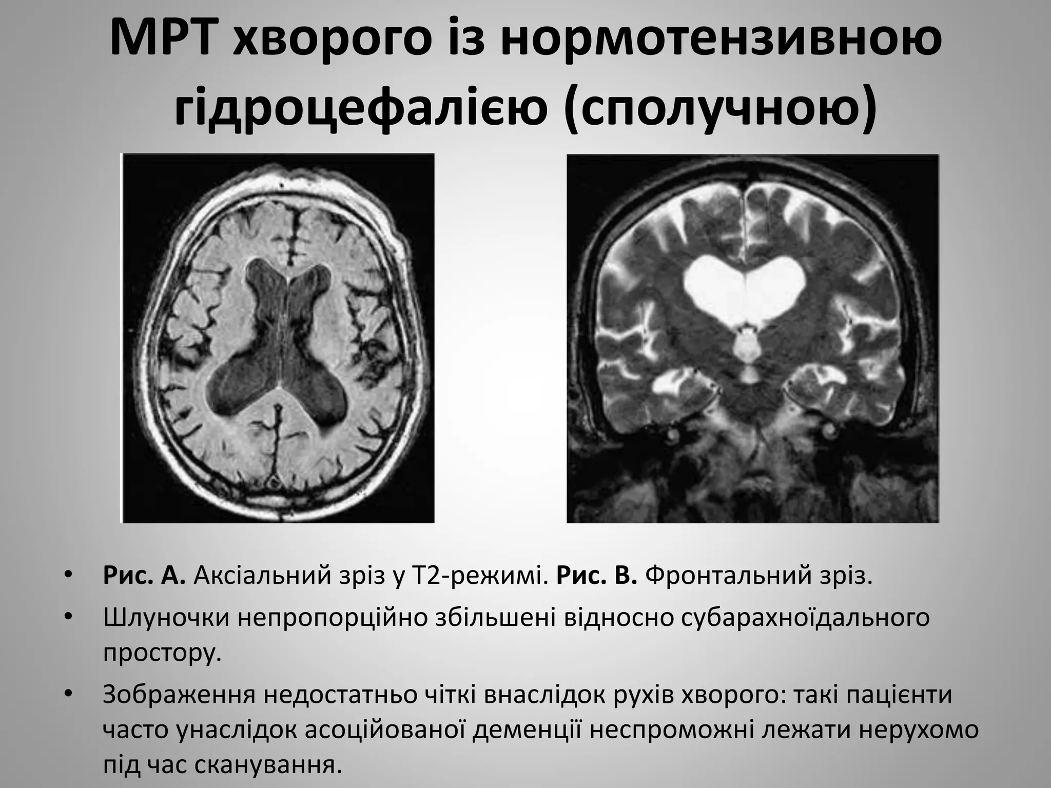 МРТ хворого із нормотензивною
гідроцефалією (сполучною)
• Рис. А. Аксіальний зріз у Т2-режимі. Рис. В. Фронтальний зріз.
• Шлуночки непропорційно збільшені відносно субарахноїдального
простору.
• Зображення недостатньо чіткі внаслідок рухів хворого: такі пацієнти
часто унаслідок асоційованої деменції неспроможні лежати нерухомо
під час сканування.
 