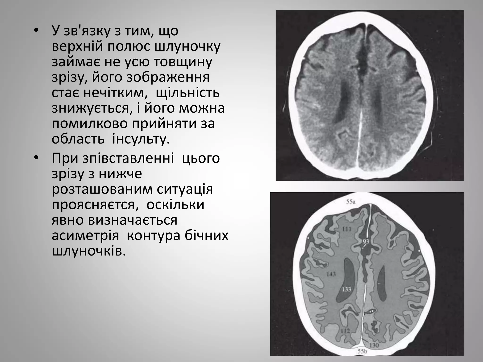 • У зв'язку з тим, що
верхній полюс шлуночку
займає не усю товщину
зрізу, його зображення
стає нечітким, щільність
знижується, і його можна
помилково прийняти за
область інсульту.
• При зпівставленні цього
зрізу з нижче
розташованим ситуація
проясняєтся, оскільки
явно визначається
асиметрія контура бічних
шлуночків.
 