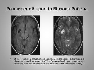 Розширений простір Вірхова-Робена
21
• МРТ, Т1-зважене зображення в аксіальній площині. Гіпоінтенсивна
ділянка в правій лушпині. На Т2-зображенні цей простір виглядає
гіперінтенсивним по відношенню до паренхіми головного мозку.
 