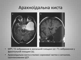 Арахноїдальна киста
25
• МРТ, Т2-зображення в аксіальній площині (а) і Т1-зображення у
фронтальній площині (Ь).
• Арахноїдальна киста в полюсі скроневої частки з сигналом,
ізоінтенсивним ЦСР.
 
