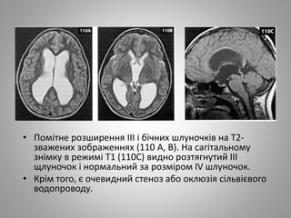 • Помітне розширення III і бічних шлуночків на Т2-
зважених зображеннях (110 А, В). На сагітальному
знімку в режимі Т1 (110С) видно розтягнутий III
щлуночок і нормальний за розміром IV шлуночок.
• Крім того, є очевидний стеноз або оклюзія сільвієвого
водопроводу.
 
