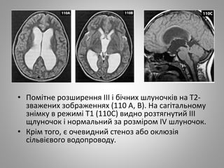 • Помітне розширення III і бічних шлуночків на Т2-
зважених зображеннях (110 А, В). На сагітальному
знімку в режимі Т1 (110С) видно розтягнутий III
щлуночок і нормальний за розміром IV шлуночок.
• Крім того, є очевидний стеноз або оклюзія
сільвієвого водопроводу.
 
