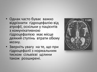 • Однак часто буває важко
відрізнити гідроцефалію від
атрофії, оскільки у пацієнтів
з комунікативною
гідроцефалією має місце
деякий ступінь втрати обєму
мозку.
• Зверніть увагу на те, що при
гідроцефалії з нормальним
тиском сільвієві щілини
також розширені.
 