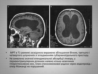 • МРТ в Т1-режимі засвідчила виражене збільшення бічних, третього і
четвертого шлуночків зі згладженням субарахноїдального простору.
• Не виявлено значної епендимальної абсорбції ліквору, у
перивентрикулярних ділянках наявно кілька невеликих
гіперінтенсивних зон, плин спинномозкової рідини через водопровід і
отвір Мажанді не порушений.
 