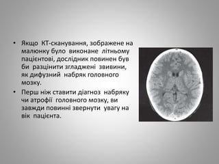 • Якщо КТ-сканування, зображене на
малюнку було виконане літньому
пацієнтові, дослідник повинен був
би разцінити згладжені звивини,
як дифузний набряк головного
мозку.
• Перш ніж ставити діагноз набряку
чи атрофії головного мозку, ви
завжди повинні звернути увагу на
вік пацієнта.
 