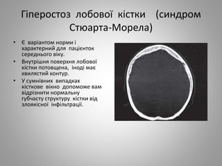 Гіперостоз лобової кістки (синдром
Стюарта-Морела)
• Є варіантом норми і
характерний для пацієнток
середнього віку.
• Внутрішня поверхня лобової
кістки потовщена, іноді має
хвилястий контур.
• У сумнівних випадках
кісткове вікно допоможе вам
відрізнити нормальну
губчасту структуру кістки від
злоякісної інфільтрації.
 