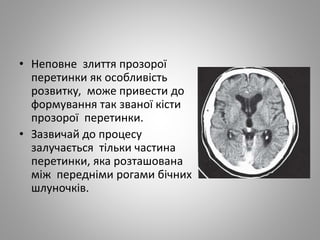 • Неповне злиття прозорої
перетинки як особливість
розвитку, може привести до
формування так званої кісти
прозорої перетинки.
• Зазвичай до процесу
залучається тільки частина
перетинки, яка розташована
між передніми рогами бічних
шлуночків.
 