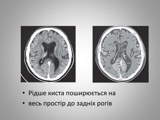 • Рідше киста поширюється на
• весь простір до задніх рогів
 