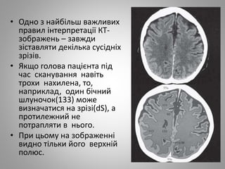 • Одно з найбільш важливих
правил інтерпретації КТ-
зображень – завжди
зіставляти декілька сусідніх
зрізів.
• Якщо голова пацієнта під
час сканування навіть
трохи нахилена, то,
наприклад, один бічний
шлуночок(133) може
визначатися на зрізі(dS), а
протилежний не
потрапляти в нього.
• При цьому на зображенні
видно тільки його верхній
полюс.
 