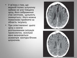 • У зв'язку з тим, що
верхній полюс шлуночку
займає не усю товщину
зрізу, його зображення
стає нечітким, щільність
знижується, і його можна
помилково прийняти за
область інсульту.
• При зпівставленні цього
зрізу з нижче
розташованим ситуація
проясняєтся, оскільки
явно визначається
асиметрія контура бічних
шлуночків.
 