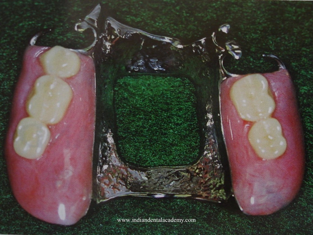 Dental Major connectors/ dental implant courses