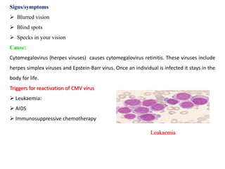 Signs/symptoms
 Blurred vision
 Blind spots
 Specks in your vision
Cause:
Cytomegalovirus (herpes viruses) causes cytomegalovirus retinitis. These viruses include
herpes simplex viruses and Epstein-Barr virus. Once an individual is infected it stays in the
body for life.
Triggers for reactivation of CMV virus
 Leukaemia:
 AIDS
 Immunosuppressive chemotherapy
Leukaemia
 