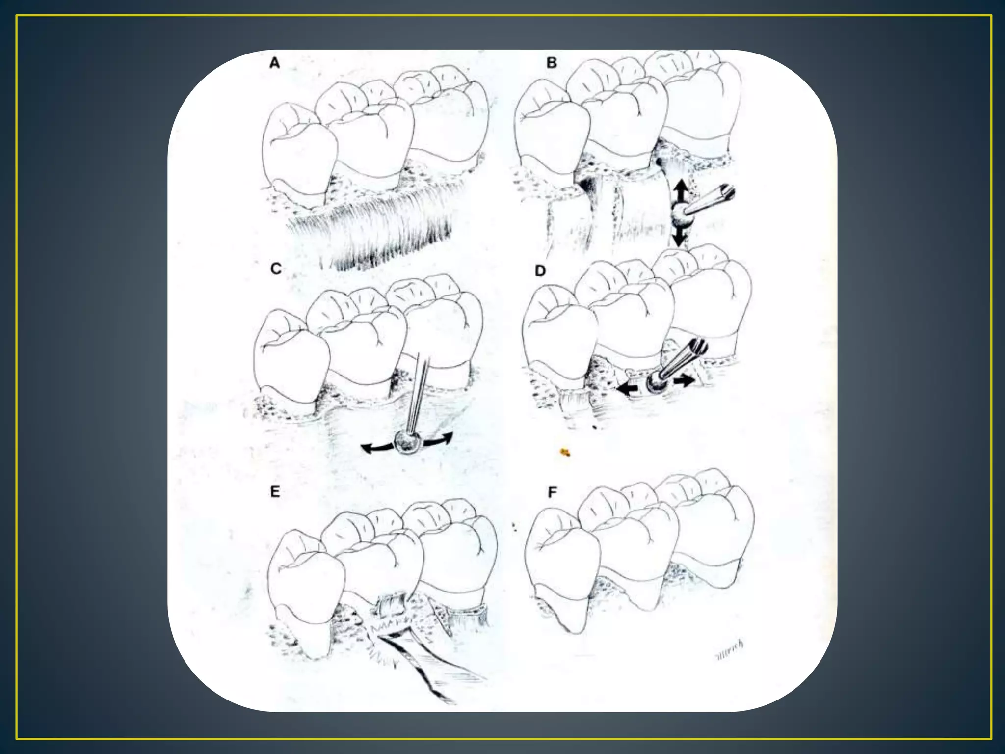 Resective osseous surgery