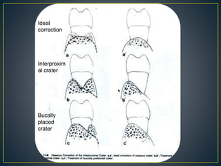 Ideal
correction
Interproxim
al crater
Bucally
placed
crater
 