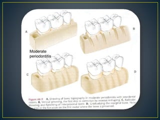 Moderate
periodontitis
 