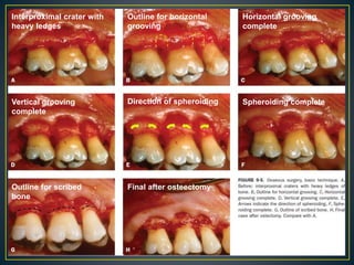 Interproximal crater with
heavy ledges
Outline for horizontal
grooving
Horizontal grooving
complete
Vertical grooving
complete
Direction of spheroiding Spheroiding complete
Outline for scribed
bone
Final after osteectomy
 