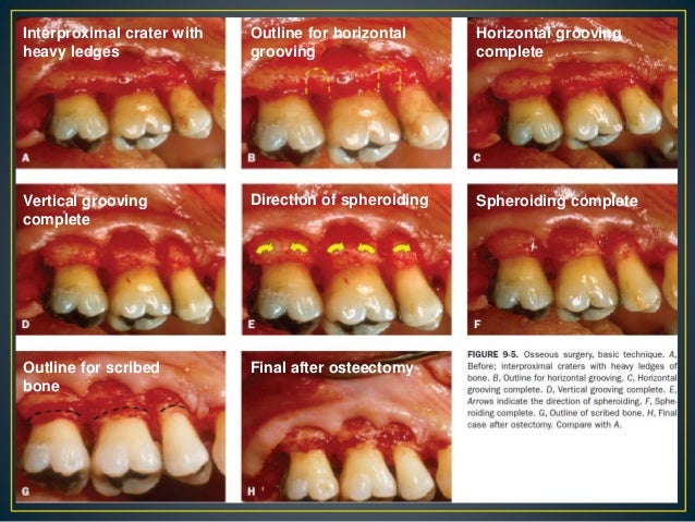 gingival curettage