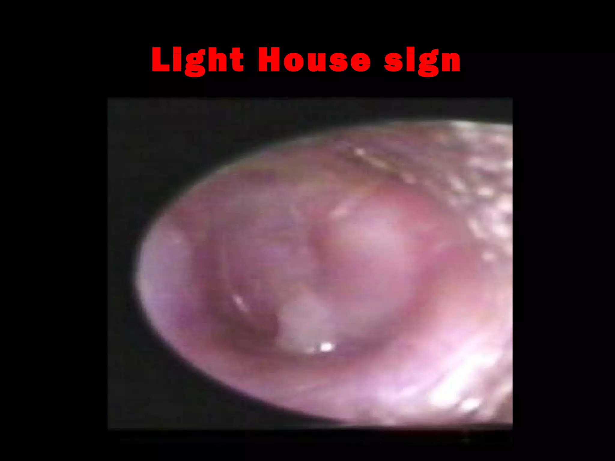 Acute suppurative otitis media | PPT
