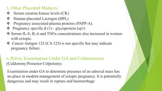 ectopic pregnancy | PPTX