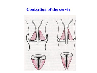Cancer of the Female Genital Tract | PPT