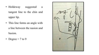 • Holdeway suggested a
tangent line to the chin and
upper lip.
• This line forms an angle with
a line between the nasion and
basion.
• Degree = 7 to 9
 