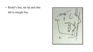 • Riedel’s line, the lip and chin
fall in straight line.
 