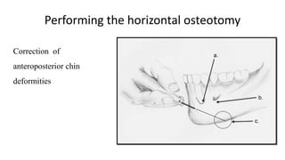 Performing the horizontal osteotomy
Correction of
anteroposterior chin
deformities
 