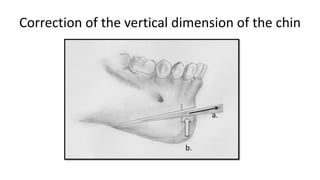 Correction of the vertical dimension of the chin
 