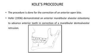 KOLE’S PROCEDURE
• The procedure is done for the correction of an anterior open bite.
• Hofer (1936) demonstrated an anterior mandibular alveolar osteotomy
to advance anterior teeth in correction of a mandibular dentoalveolar
retrusion.
 