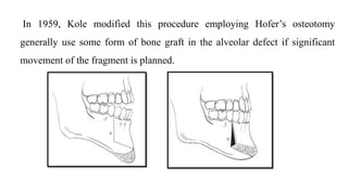 In 1959, Kole modified this procedure employing Hofer’s osteotomy
generally use some form of bone graft in the alveolar defect if significant
movement of the fragment is planned.
 