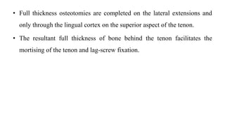 • Full thickness osteotomies are completed on the lateral extensions and
only through the lingual cortex on the superior aspect of the tenon.
• The resultant full thickness of bone behind the tenon facilitates the
mortising of the tenon and lag-screw fixation.
 