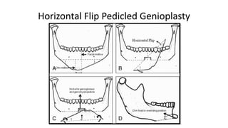 Horizontal Flip Pedicled Genioplasty
 