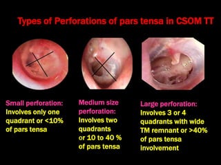 Small perforation:
Involves only one
quadrant or <10%
of pars tensa
Types of Perforations of pars tensa in CSOM TT
Medium size
perforation:
Involves two
quadrants
or 10 to 40 %
of pars tensa
Large perforation:
Involves 3 or 4
quadrants with wide
TM remnant or >40%
of pars tensa
involvement
 