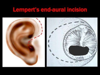Lempert’s end-aural incision
 