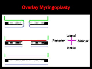 Overlay Myringoplasty
 