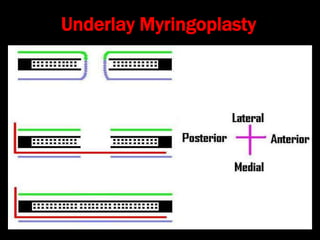 Underlay Myringoplasty
 