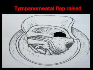 Tympanomeatal flap raised
 