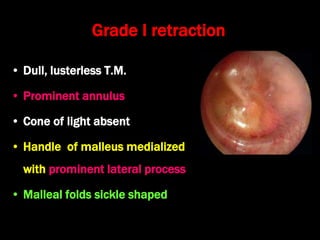 Grade I retraction
• Dull, lusterless T.M.
• Prominent annulus
• Cone of light absent
• Handle of malleus medialized
with prominent lateral process
• Malleal folds sickle shaped
 