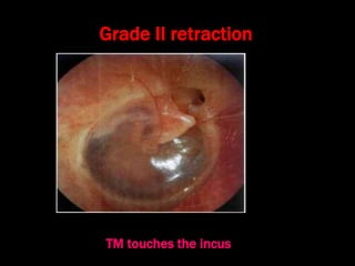 Grade II retraction
TM touches the incus
 