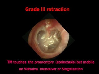Grade III retraction
TM touches the promontory (atelectasis) but mobile
on Valsalva maneuver or Siegelization
 