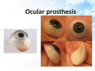 Ocular prosthesis
 