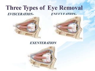 Three Types of Eye Removal
EVISCERATION- ENUCLEATION-
EXENTERATION
 