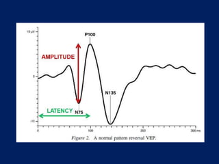 VISUAL EVOKED POTENTIAL | PPT