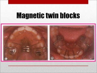 Magnetic twin blocks
 