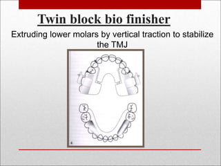 Twin block bio finisher
Extruding lower molars by vertical traction to stabilize
the TMJ
 